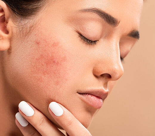 Let’s Talk Pimples, Blemishes & That Glow-Up Life