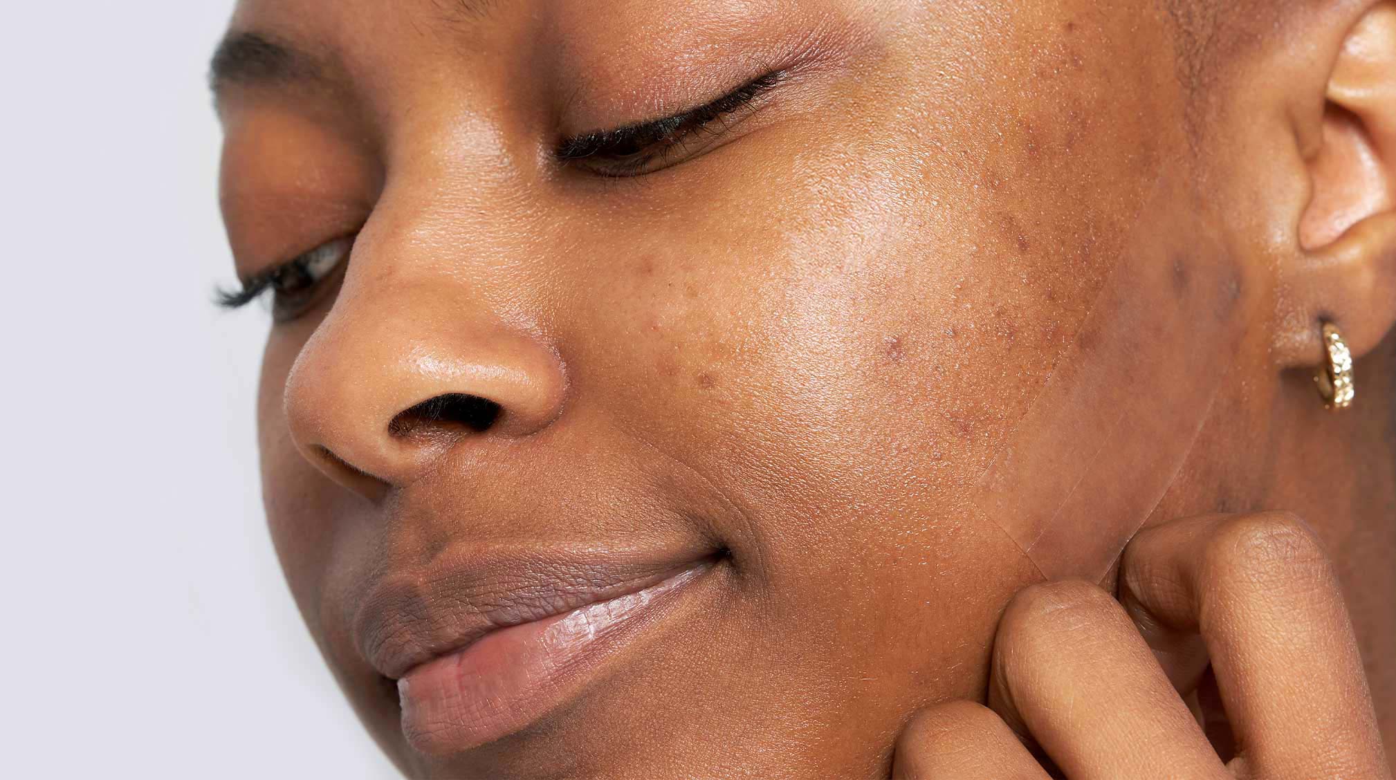 The Ultimate Guide: Acne, Acne Scars, Eczema, and Skin Brightening